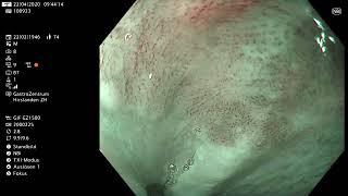 Squamous Cell Carcinoma -using NBI and TXI with Lugol for delineation