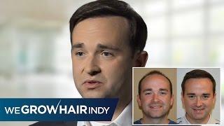 Hair transplant - PAI Medical Group's Latest Featured Client (Nick)