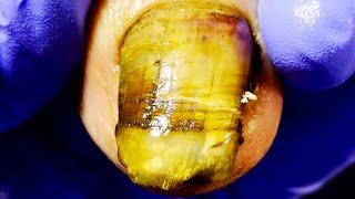 Thoroughly Trim The Nail Fungus! Remove Dirt[Doctor Liu Pedicure]