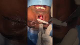 Redo Nose Surgery where the earlier placed silicon implant is being removed