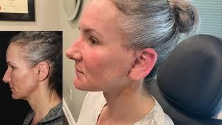 Facelift Surgery | 10 Days Before and After Results | Toronto Facelift Surgeon Dr. Philip Solomon