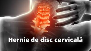 Ce este hernia de disc cervicală #kinetoterapie #durerecervicala