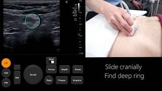 Ultrasound Tutorial: Inguinal/Femoral Hernia Assessment | Radiology Nation