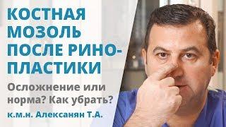 Костная мозоль после ринопластики: осложнение или норма?