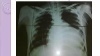Acute heart failure