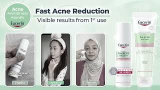  Celebrate Acne Awareness Month with Real Results 
