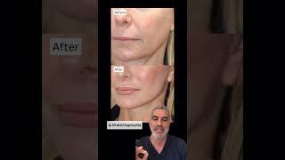 How to Get NATURAL Facelift Results!