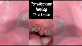 Tonsillectomy Healing Over 25 Days in 30 Seconds #shorts @fauquierent