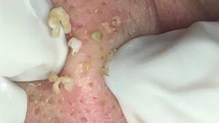  Pimple Popping 2020 Video| Super blackheads removal in nose| Blackheads extraction| Acne removal