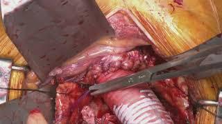 AAAR, type3b endoleak