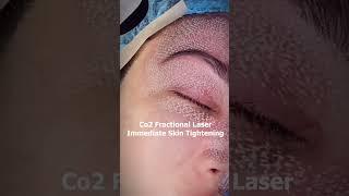 Say Goodbye to Wrinkles CO2 Laser Lift ️ #flawlessskin