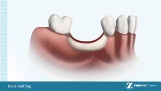 Introduction to Bone Grafting