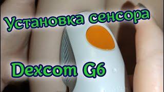 Установка сенсора Dexcom G6. Самая лёгкая установка из всех сенсоров.