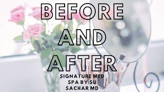 BEFORE AND AFTERS FROM SIGNATURE MED SPA!