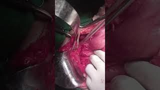 Gallbladder perforation due to ascaris infestation - Supplementary video [ID 421611]