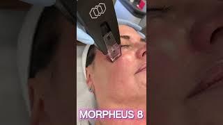 TIGHTEN & FIRM YOUR FACE AND NECK WITH MORPHEUS 8! #morpheus #morpheus8 #viralvideo