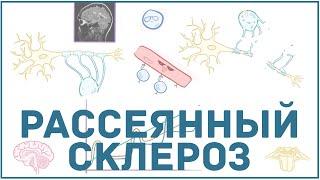 Рассеянный склероз - причины, симптомы, диагностика, лечение