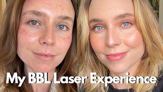 My BBL Laser Experience: What You Need To Know (BroadBand Light Photofacial)