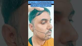 Best hair transplant in jabalpur  | Beard transplant in jabalpur #shorts #shortsfeed #viral #amazing