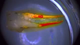 Premolar failure, my RCT from 2015-16