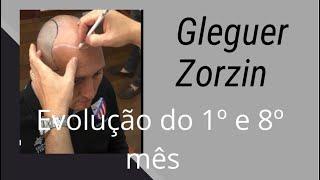 Ex GOLEIRO CORINTHIANS - GLEGUER ZORZIN. 8 meses após transplante capilar.