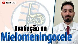 Avaliação na Mielomeningocele (Aula completa) - Prof. Dr. Rodolfo Kós