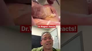 EXTRACTION OF INGROWN TOENAIL  #shorts #ingrownnail #ingrown #ingrowntoenail