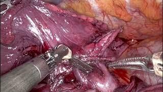 Cerfolio Surgery: Robotic Segmentectomy S3, Anterior Segment of the RUL