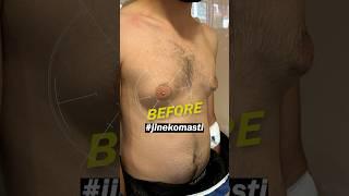 Gynecomasty Surgery Before-After #gynecomastiaresult