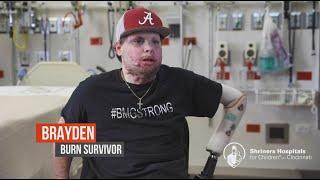 Burn Survivor Brayden makes major improvements with Shriners Hospital for Children Cincinnati