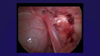 Laparoscopic Orchidopexy