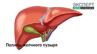 Полипы желчного пузыря