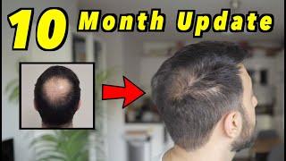 10 Month 2nd Hair Transplant Update | 4000 GRAFTS FUE | HAIR IS GROWING | SMP?