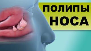 ПОЛИПЫ НОСА, причины, тактика лечения