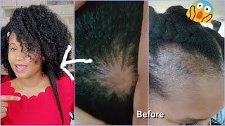 How I Reversed My Alopecia And Grew Extremely long hair Fast || Regrow Hair Stop thinning baldness