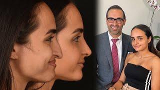 Saba's Rhinoplasty Six Days Post-Procedure