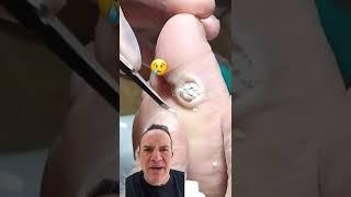 DOCTOR REACTS: AMAZING PLANTAR WART CURE!  #shorts