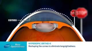 Long-sighted Ortho-keratology - Can long sighted people have Orthokeratology? Rose Optometrists