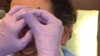 Dr. Paul M. Friedman Receiving Botox Treatment for Forehead and Glabella Lines