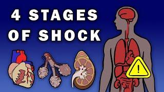 THE 4 STAGES OF SHOCK