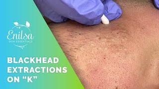 Blackhead Extrations on "K" - He's back!