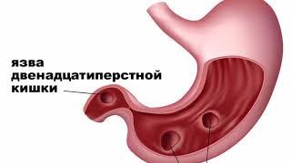 Ун Икки Бармокли Ичак Ярасидан Буткул Халос Килувчи Оддий Дамлама !!!