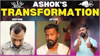 #AskDrJohnWatts | ISMART ASHOK’S TRANSFORMATION | Hair Specialist Explains