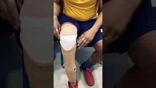 Below knee amputee walking naturally with Ossur carbon foot