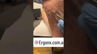 Painful corn cutting from foot by podiatrist in australian podiatry clinic