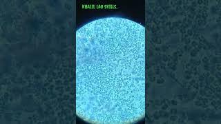urine sample ||what is the  diagnosis.