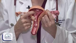 Tumores Uterinos || Medical Toursv