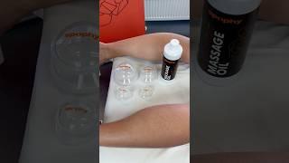 Cupping the calf with Spophy Cupping Set to relieve muscle tension