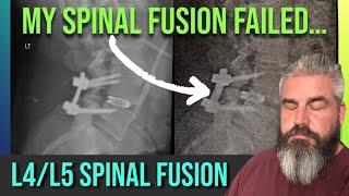 L4/L5 Spinal Fusion Failure 2 Weeks After Surgery.....Now WHAT???