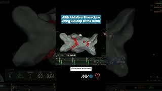 AFib Ablation Procedure Using 3D Map of Heart